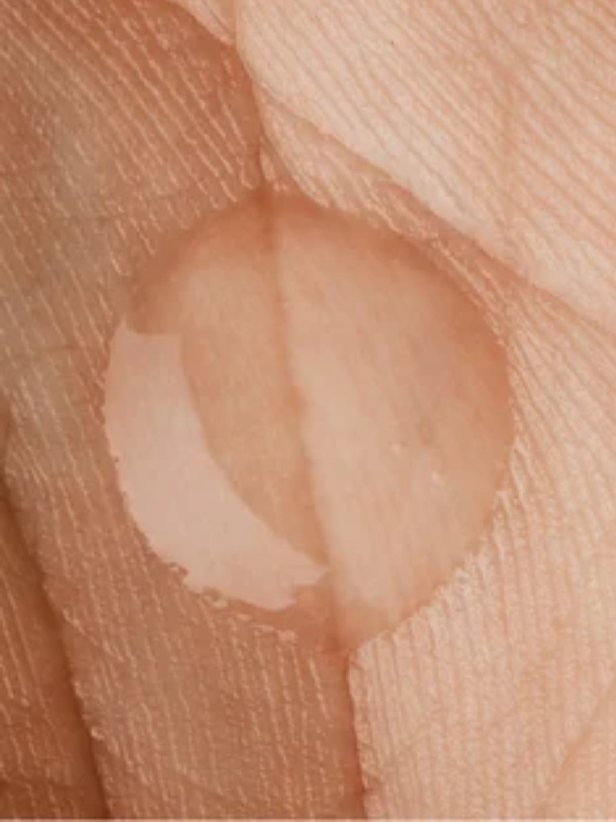 Close-up of a skin lesion on a person's arm