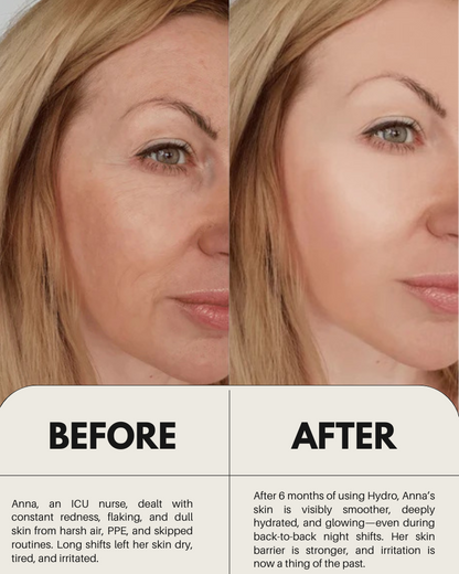 Before and after results using Hydro moisturizer — reduced redness and smoother skin
